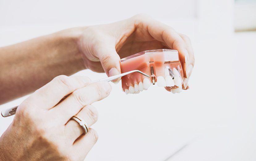 implantes dentales en Vitoria Gasteiz