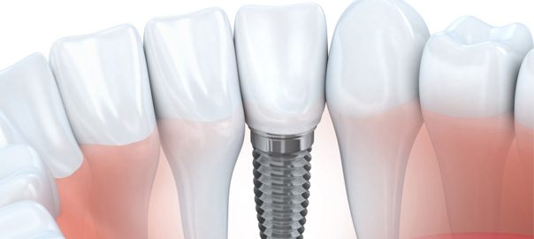 Qué beneficios tienen los implantes dentales
