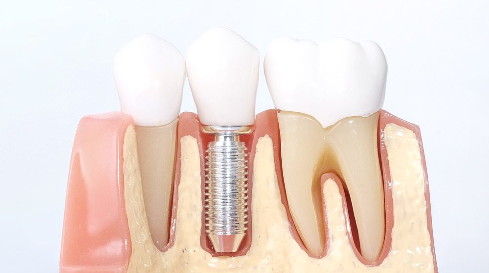 Cuál es el precio de un implante dental