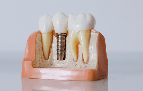 beneficios de la rehabilitación oral con implantes dentales