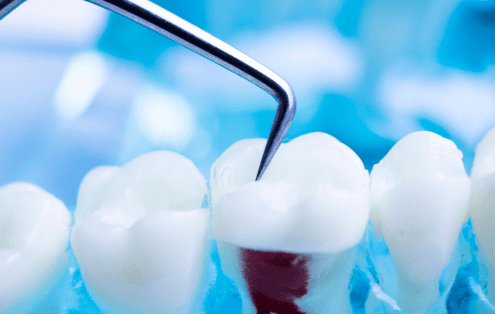 Por qué podría necesitar una endodoncia