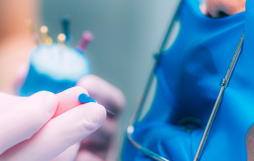 Por qué se realiza una endodoncia
