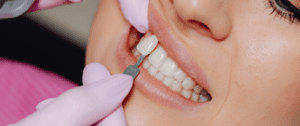 Qué son las carillas dentales